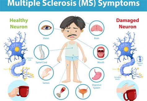 How does Multiple Sclerosis affect the Brain, Spinal cord, and Immune ...