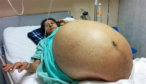 Terrifying! The Story Mexican Women Whose Weight Increased To 275 ...