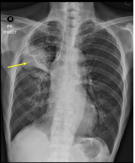 Non-small cell lung cancer: Adenocarcinoma – Radiology Cases