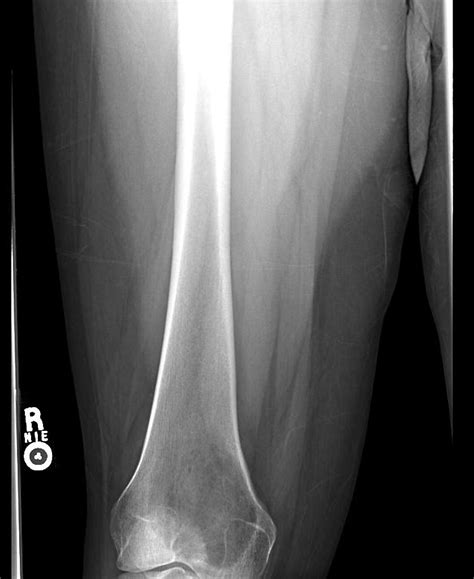 Giant cell tumor of bone - wikidoc