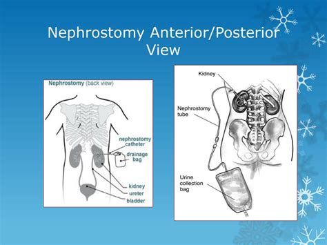 Nephrostomy Tube Types