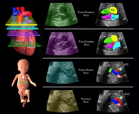 Fetal Echocardiography