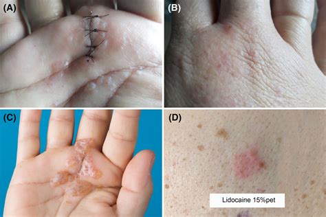 A case of postoperative bullous allergic contact dermatitis caused by injection with lidocaine ...