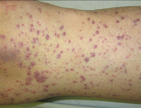 Scurvy causes, symptoms, scurvy skin rash, diagnosis & scurvy treatment