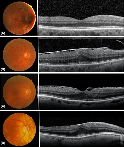 Epiretinal Membrane Oct