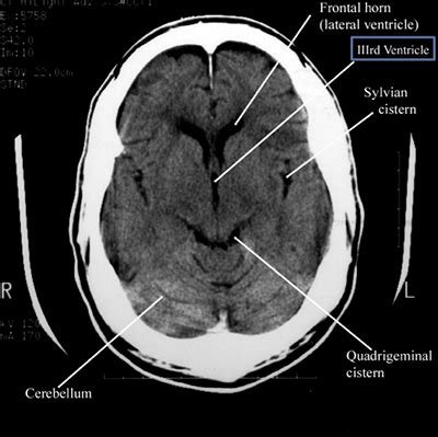 Lateral Ventricle Coronal Section