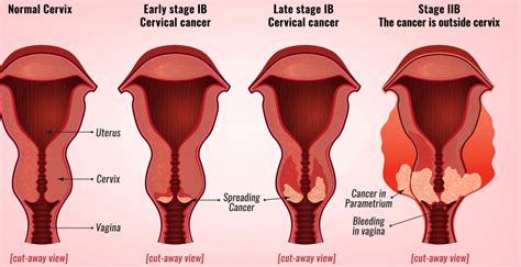 Cervical Cancer Stages | YourCareEverywhere