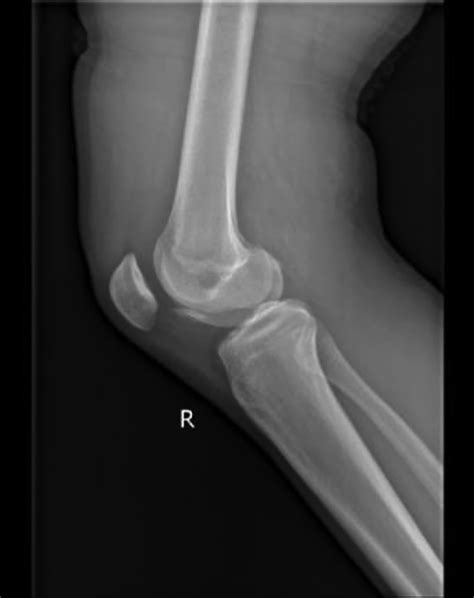 Femoral Condyle Fracture Treatment