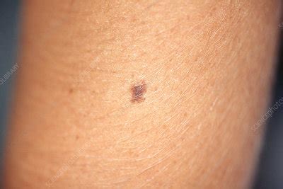 Dysplastic Nevus - Stock Image - C043/0635 - Science Photo Library