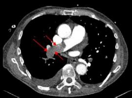 Successful Treatment of Renal Cell Carcinoma Pulmonary Embolism Using ...