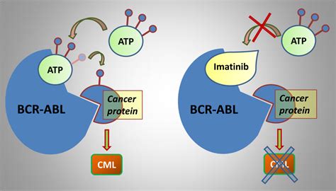 Chronic Myeloid Leukemia/Chronic Myelogenous Leukemia (CML) - Stepwards