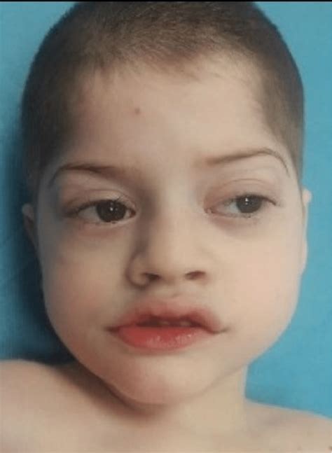 Facial dysmorphism in a 5-year-old boy with Pitt Hopkins syndrome (at ...