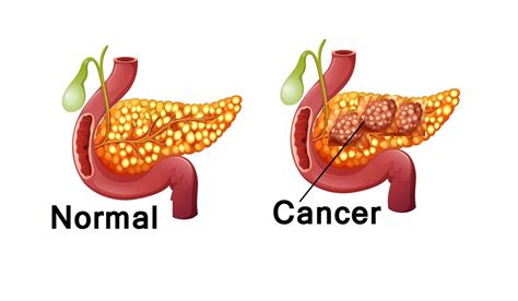 Pancreatic Cancer Treatment in India | Best Doctors for Surgery | Cost