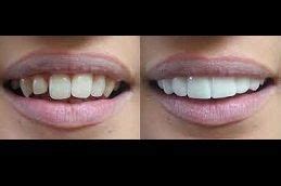 Protruded Teeth Treatment in Dubai & Abu Dhabi | Protruded Teeth Cost