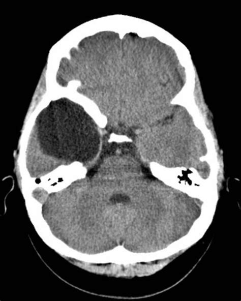 Arachnoid cyst of the middle cranial fossa | Radiology, Radiology ...