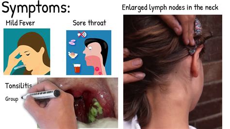 Infectious mononucleosis - Easy explained - YouTube