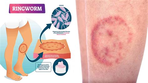 Ringworm Symptoms, Causes, and Treatments Never to Ignore