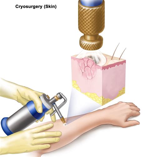 Cryosurgery treatment in Bengaluru | ID: 18847526930