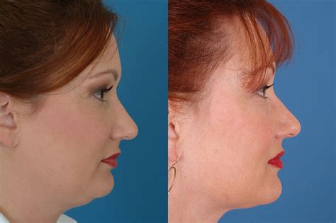 Neck Liposuction Before & After Photos | Dr. Bassichis