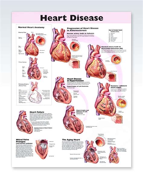 Heart Disease Exam Room Anatomy Poster – ClinicalPosters