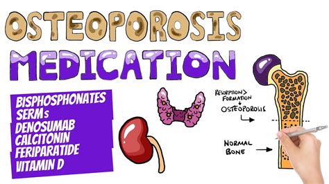 Osteoporosis Medications and Management | Which Drugs Are Used To Treat Osteoporosis? - YouTube