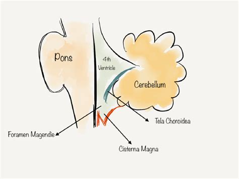 Is it an arachnoid cyst or a mega cisterna magna? What to and where to ...