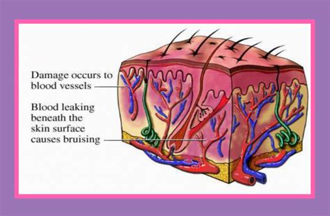 Bruise Easily? Dieting may increase your risk for bruises unless you ...