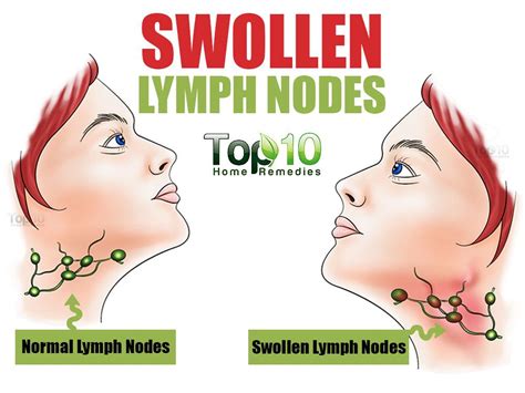 Home Remedies for Swollen Lymph Nodes | Swollen lymph nodes, Lymph nodes, Remedies for swollen ...