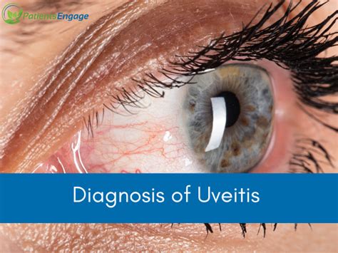 Tests For Diagnosis Of Uveitis | PatientsEngage