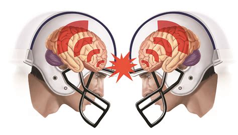 Do helmets protect against concussion? - Queensland Brain Institute ...