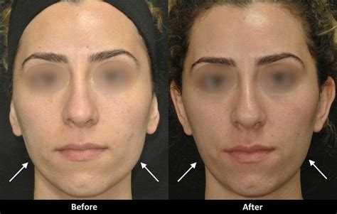 Slim Your Face with Botox