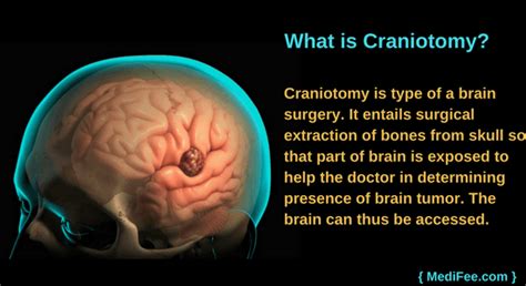 Craniotomy - Brain Surgery