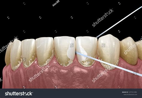 Oral Hygiene Using Dental Floss Plaque Stock Illustration 1277313781 ...