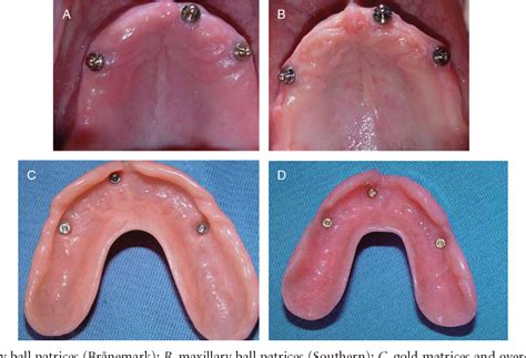 Figure 2 from Patient satisfaction with maxillary 3-implant overdentures using different ...