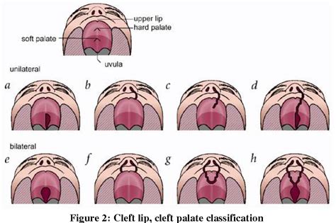 [PDF] CLEFT LIP AND PALATE; A COMPREHENSIVE REVIEW | Semantic Scholar