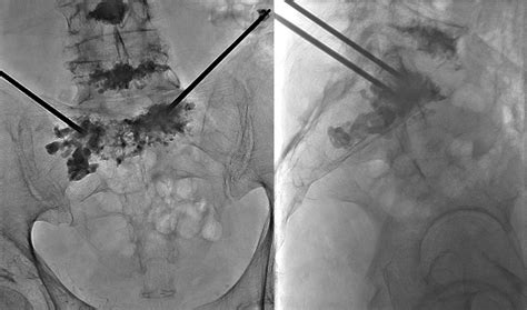 E-018 percutaneous sacroplasty for the management of painful pathologic fracture in a multiple ...