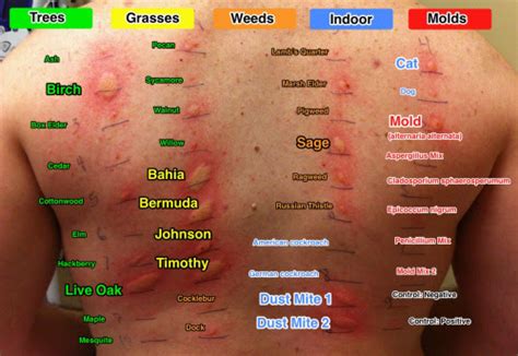 Allergy Skin Test - Allergy Immunology Specialists