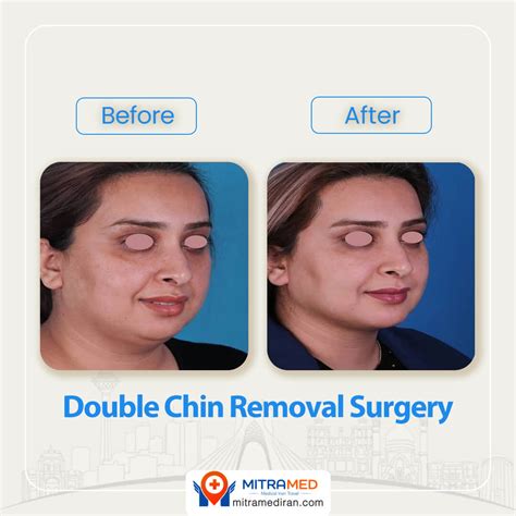 Double Chin Surgery in Iran | Double Chin Removal | MITRAMED