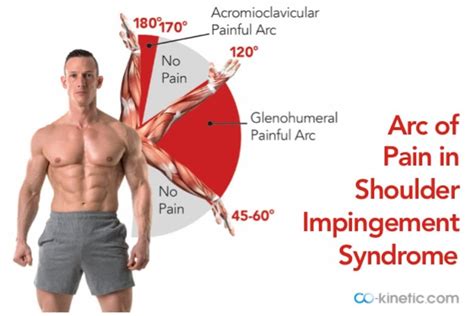 Feeling The Pinch? Stubborn Shoulder Impingement Syndrome - Massage ...