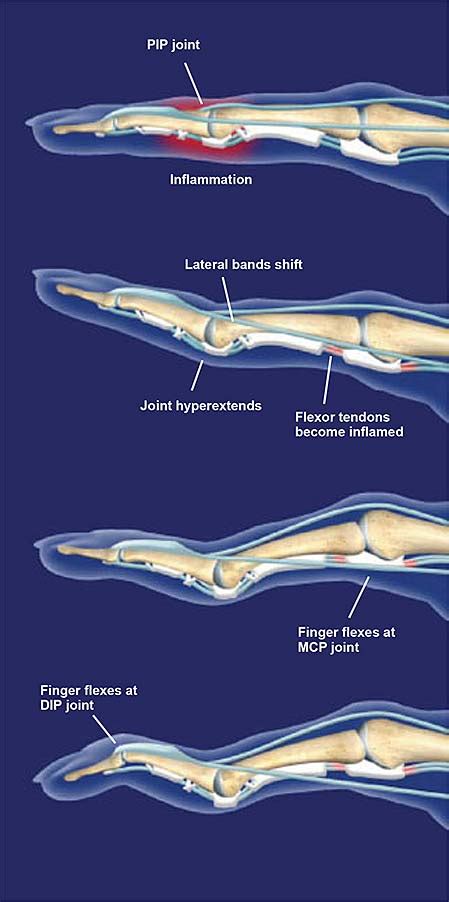 Swan Neck Deformity | Central Coast Orthopedic Medical Group