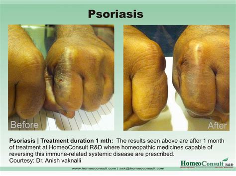 HomeoConsult RD: Psoriasis homeopathy treatment and cure