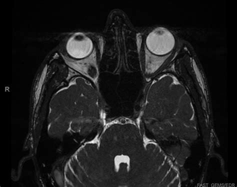 Microvascular Decompression and Radiofrequency Lesioning for Trigeminal Neuralgia - cns.org