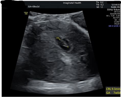 7 Week Transvaginal Ultrasound