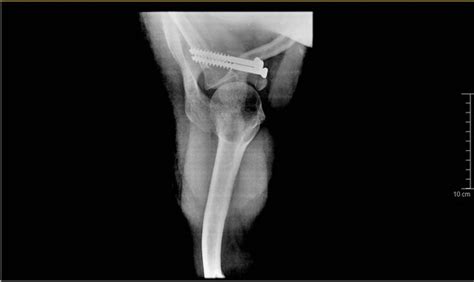 An Isolated Displaced Fracture of the Coracoid Process Treated with Osteosynthesis—A Case Report ...