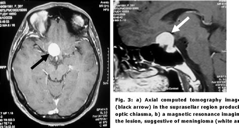 Figure 3 from Atypical presentation of suprasellar meningioma ...