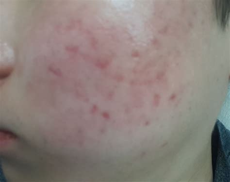 Severe smooth red acne scars :( – Hyperpigmentation – red/dark marks – Acne.org Forum