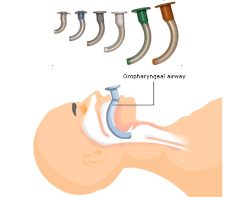 [TNCC] Oropharyngeal airway (OPA), nasopharyngeal airway (NPA) : 네이버 블로그