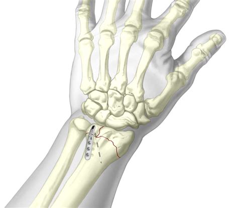 Dorsal Ulnar Pin Plate - Upper Extremity Fixation - TriMed Inc.