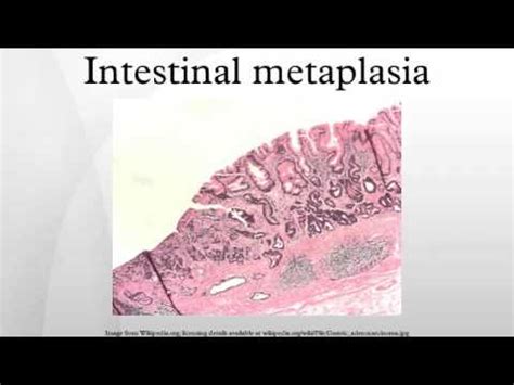 Intestinal metaplasia - YouTube