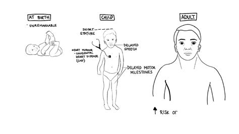 Noonan Syndrome a genetic condition - Gerber Ambulance News - General ...